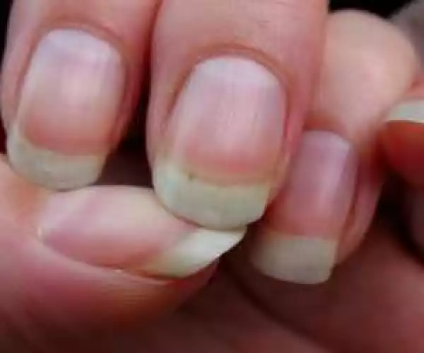 Doctors Warn That Finding THIS On Your Nail Could Be Serious (AIDs Found too)